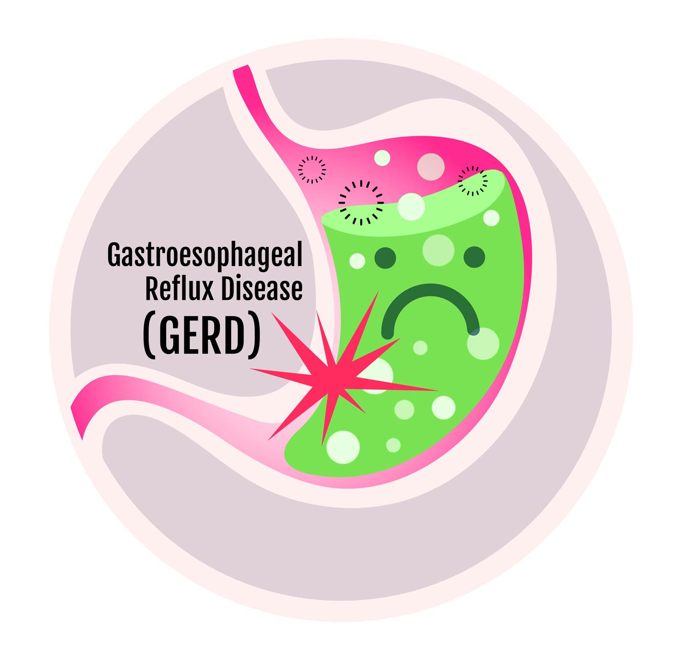 Gastroesophageal reflux disease (GERD) illustration