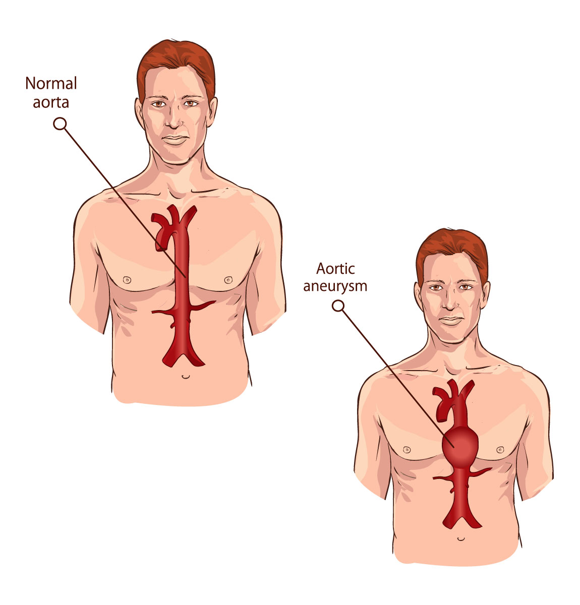 Normal aorta and aorta with aneurysm illustration