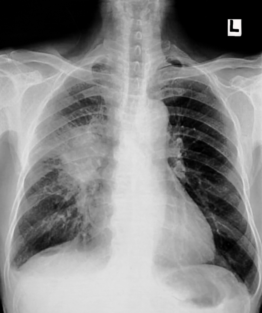 Lung cancer caused by asbestos