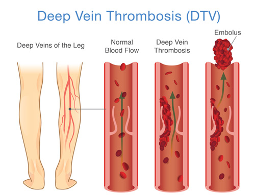 Illustration of deep vein thrombosis occurring in a leg.