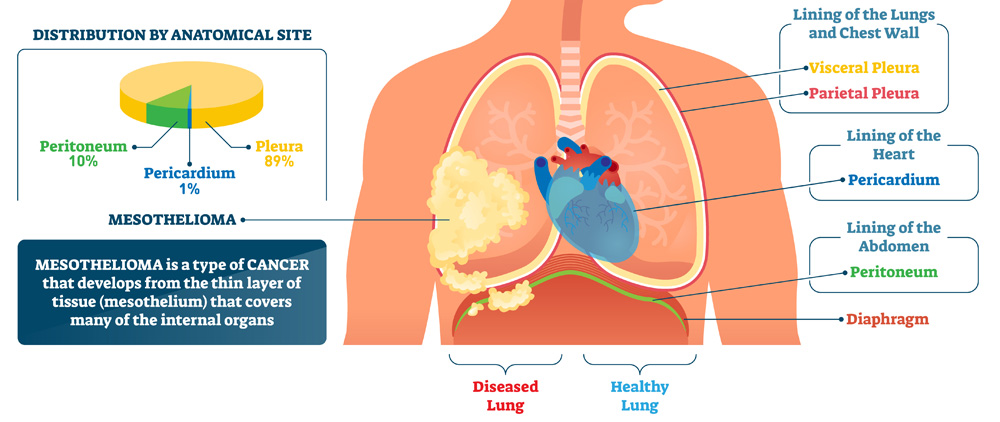 Diagram of the different types of mesothelioma.