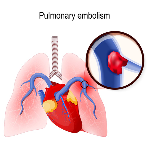 Diagram of a pulmonary embolism blocking blood flow to the lungs.