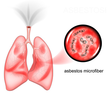 Asbestos