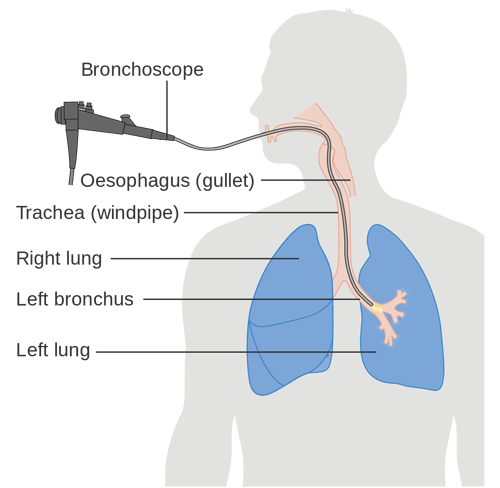 Diagram of a bronchoscopy.