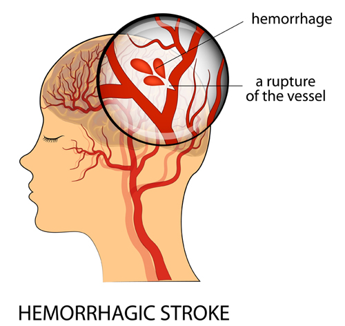 Diagram showing hemorrhagic stroke.