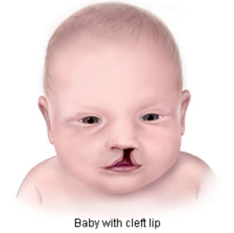 Illustration of a baby with a cleft lip.