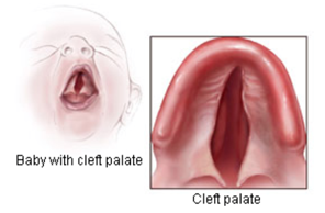 Illustration of a baby with a cleft palate.