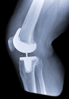 Xray view of the Arthrex iBalance TKA knee replacement.