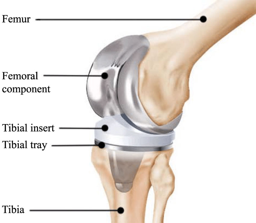 Diagram of knee replacement components.