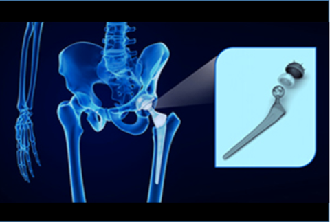 Depiction of an artificial hip implant.