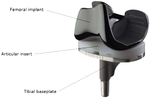 Diagram of the Smith and Nephew BCS Journey Knee System.