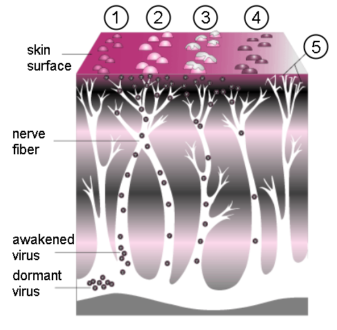 Diagram showing the progression of shingles.