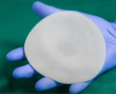 Breast implant held in a surgeon’s hand.