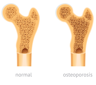 Comparison of a normal bone versus a bone with osteoporosis.