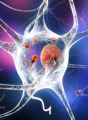 Neuron with lewy bodies and parkinsons disease.