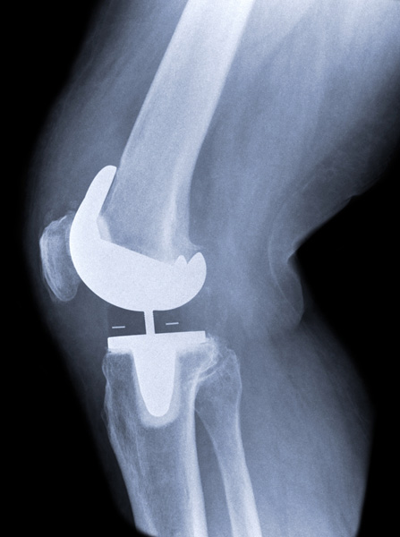 Exactech knee replacement.