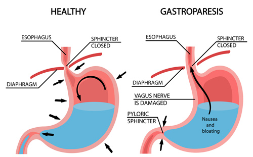 Image comparing a healthy stomach versus a stomach with gastroparesis.