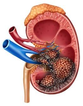 PFAS and kidney cancer.