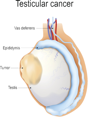 PFAS and testicular cancer.