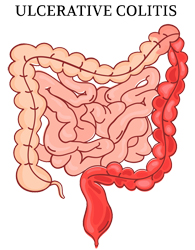 PFAS and ulcerative colitis.
