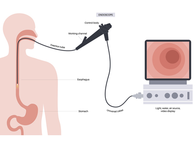 Olympus endoscope lawsuit.